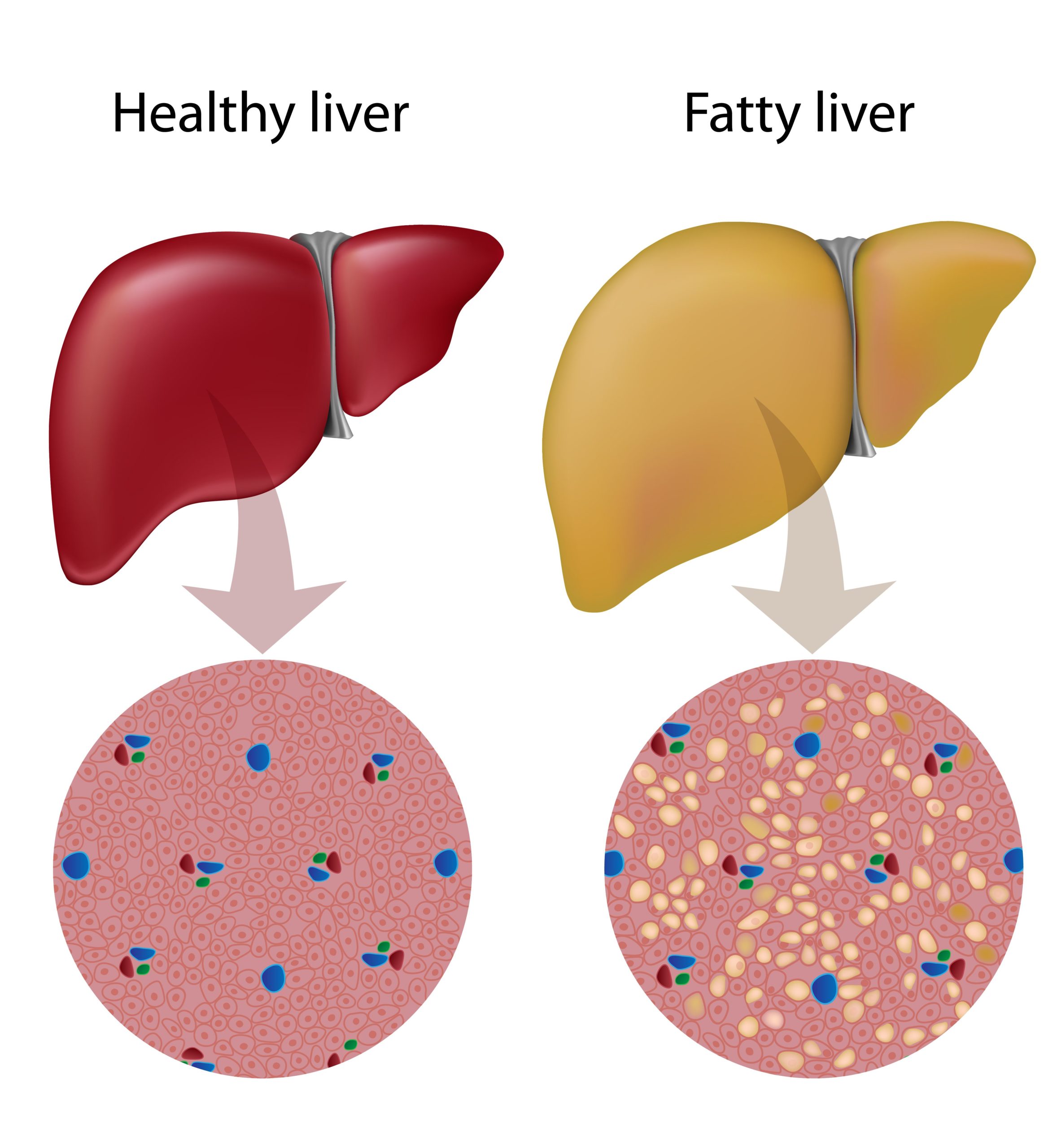 Fatty liver in clearance cats